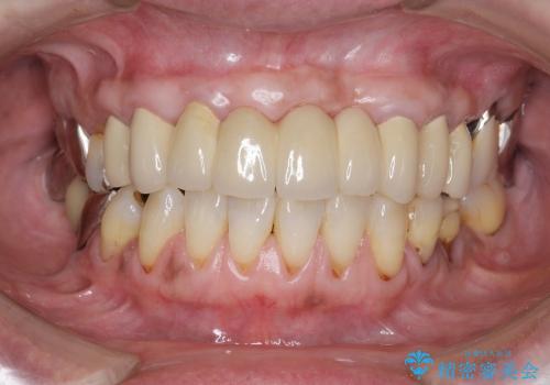 [歯周ポケット除去]  歯周病を改善してからの前歯部ブリッジの治療後