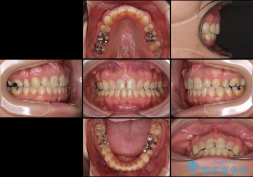 咬み合わない前歯を改善　奥歯への負担も軽減できた抜歯矯正　の治療後