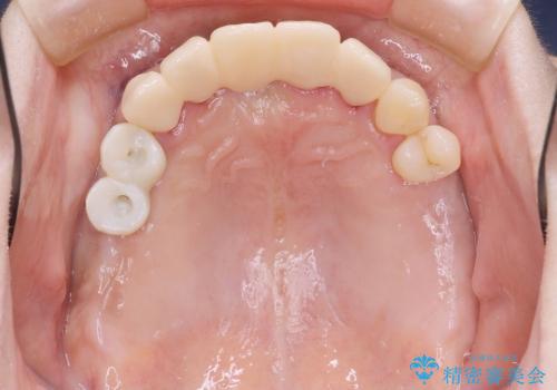 [重度歯周病] インプラントを用いた歯周病全体治療の治療中