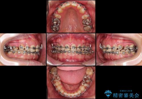 咬み合わない前歯を改善　奥歯への負担も軽減できた抜歯矯正　の治療中
