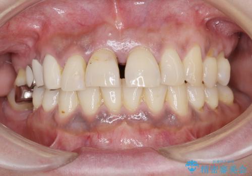 [重度歯周病] インプラントを用いた歯周病全体治療の治療前