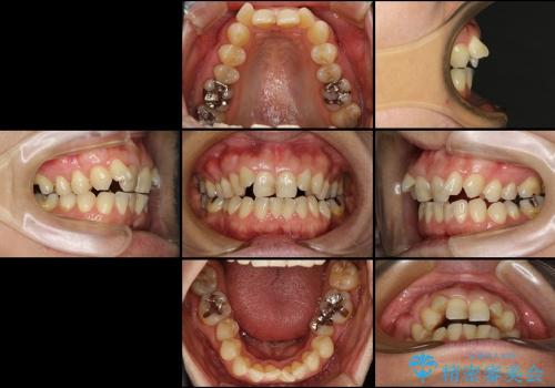 咬み合わない前歯を改善　奥歯への負担も軽減できた抜歯矯正　の治療前