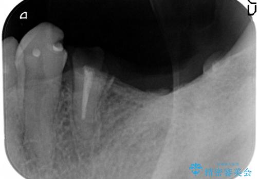 [歯がなくなった場合]  インプラントによる咬合回復の治療前