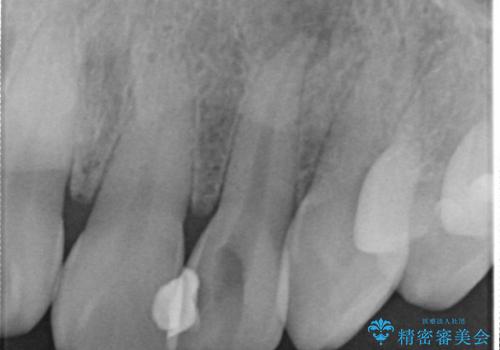 [ジルコニアクラウン]  根管治療を伴った前歯部セラミック治療の治療前