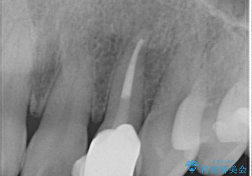 [ジルコニアクラウン]  根管治療を伴った前歯部セラミック治療の治療中