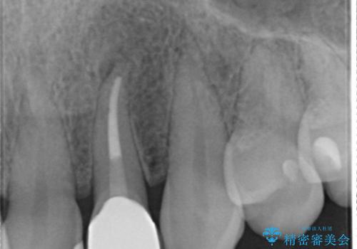 [ジルコニアクラウン]  根管治療を伴った前歯部セラミック治療の治療中