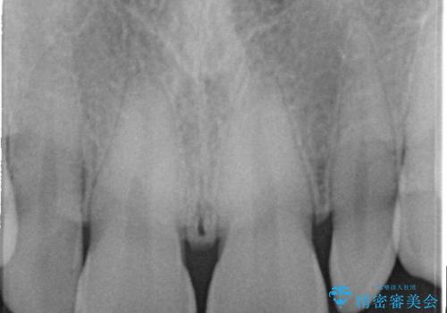 正中のすき間の部分矯正と矮小歯のオールセラミックによる治療の治療前