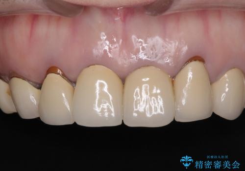 前歯のメタルボンドを透明感のあるオールセラミックへ　の治療前
