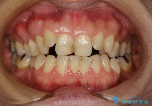 咬み合わない前歯を改善　奥歯への負担も軽減できた抜歯矯正　