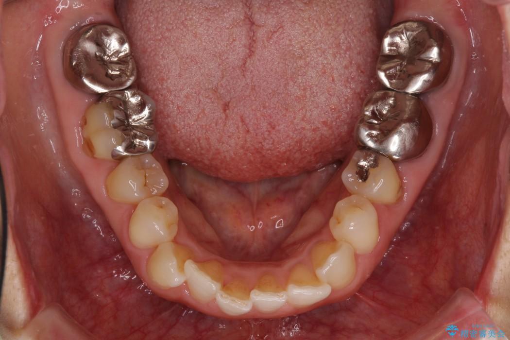 高さの足りない奥の銀歯をセラミッククラウンに｜（医）精密審美会