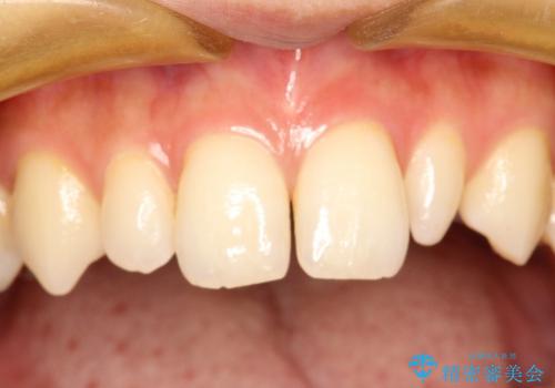 正中のすき間の部分矯正と矮小歯のオールセラミックによる治療の治療前