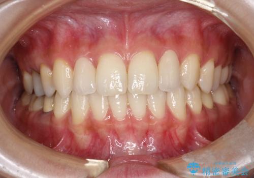 正中のすき間の部分矯正と矮小歯のオールセラミックによる治療の治療後