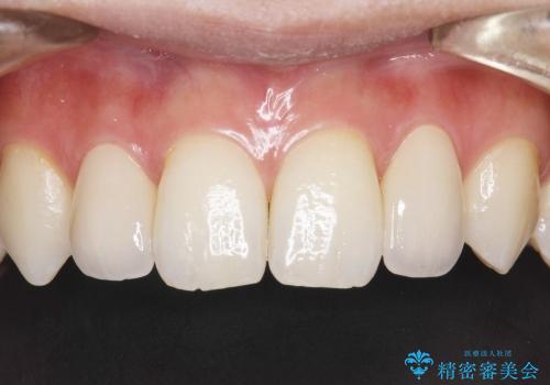 正中のすき間の部分矯正と矮小歯のオールセラミックによる治療の治療後