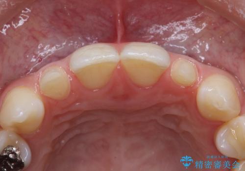正中のすき間の部分矯正と矮小歯のオールセラミックによる治療の治療中