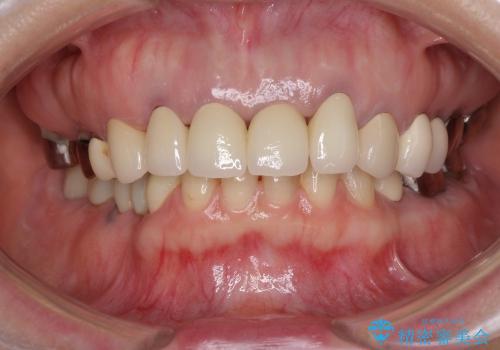 前歯のメタルボンドを透明感のあるオールセラミックへ　の治療後