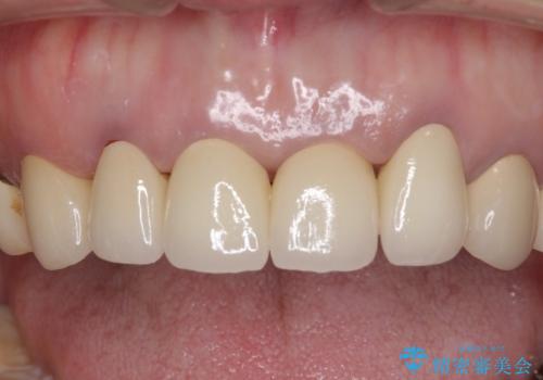 前歯のメタルボンドを透明感のあるオールセラミックへ　の治療後