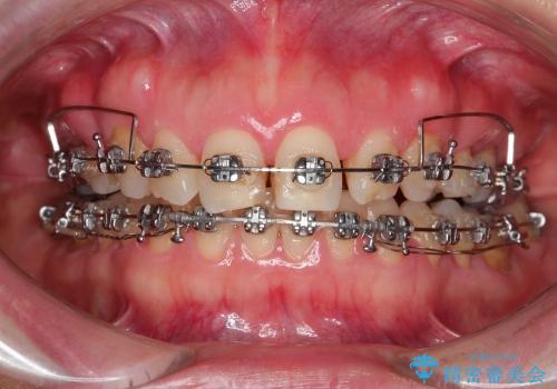 咬み合わない前歯を改善　奥歯への負担も軽減できた抜歯矯正　の治療中