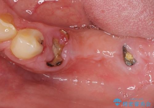 [歯がなくなった場合]  インプラントによる咬合回復の治療前