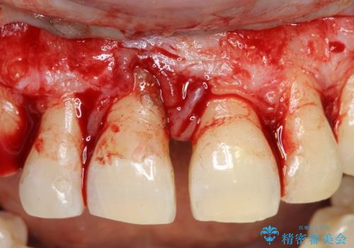 [重度歯周病] インプラントを用いた歯周病全体治療