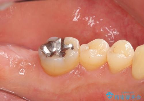 [重度歯周病] インプラントを用いた歯周病全体治療の治療後