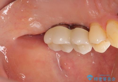 [重度歯周病] インプラントを用いた歯周病全体治療の治療後