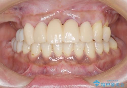 [重度歯周病] インプラントを用いた歯周病全体治療の治療中