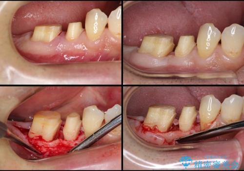 歯槽骨の再生治療を用いた歯周病治療の治療中