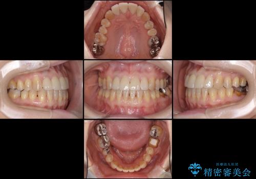 虫歯で切端咬合の前歯　咬み合わせを改善してからオールセラミックへの治療後