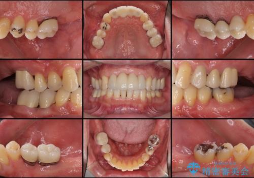 歯槽骨の再生治療を用いた歯周病治療の治療後