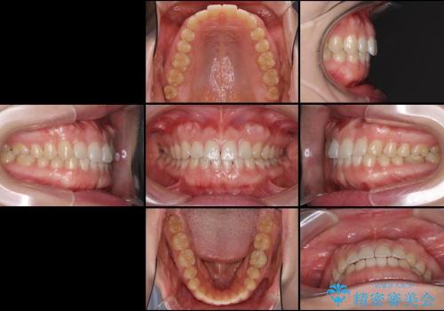ASOアライナーによる、軽微な歯列不正の矯正治療の治療前