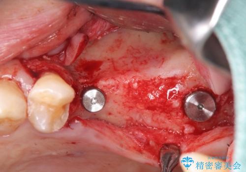 [歯が割れた] 咬み合わせが強い場合のインプラント治療の治療中