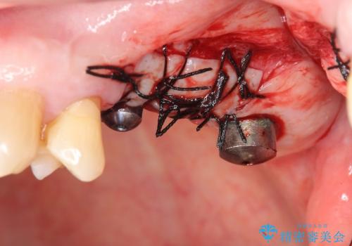 [歯が割れた] 咬み合わせが強い場合のインプラント治療の治療中