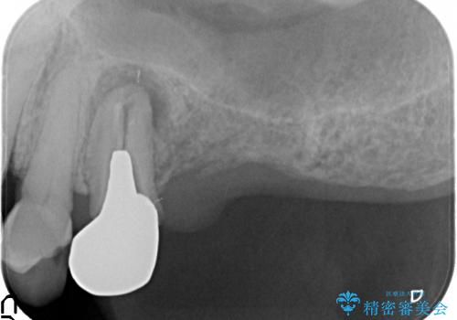 [歯が割れた] 咬み合わせが強い場合のインプラント治療の治療前
