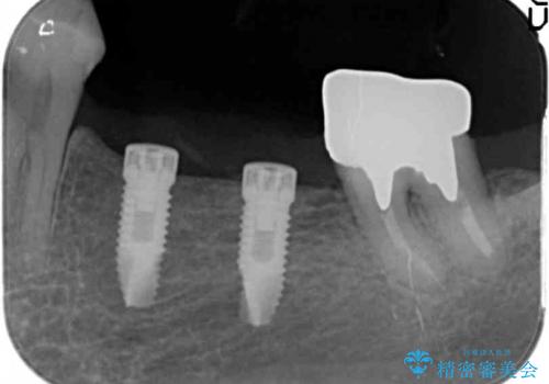 骨幅が薄い　奥歯のインプラント治療　GBR(骨増生)の治療中