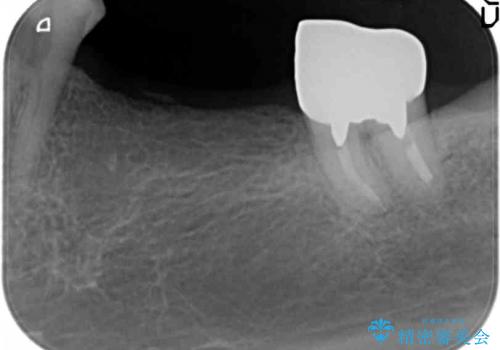 骨幅が薄い　奥歯のインプラント治療　GBR(骨増生)の治療前