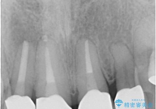40代女性　矯正後の前歯の完成の治療後