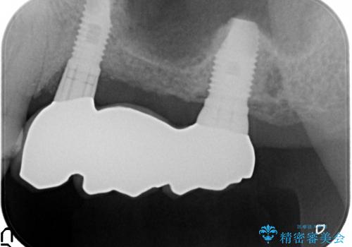 [歯が割れた] 咬み合わせが強い場合のインプラント治療の治療後