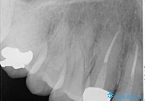 前歯のかぶせ物のやり変えによる歯肉の腫れの改善の治療後