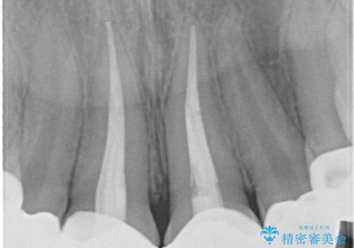 前歯の精密な被せ物による歯周組織の改善の治療後