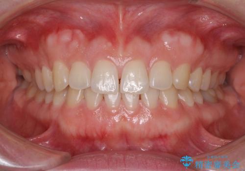 ASOアライナーによる、軽微な歯列不正の矯正治療の治療前