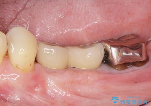 骨幅が薄い　奥歯のインプラント治療　GBR(骨増生)の治療後