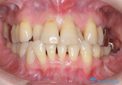 骨幅が薄い　奥歯のインプラント治療　GBR(骨増生)の治療後