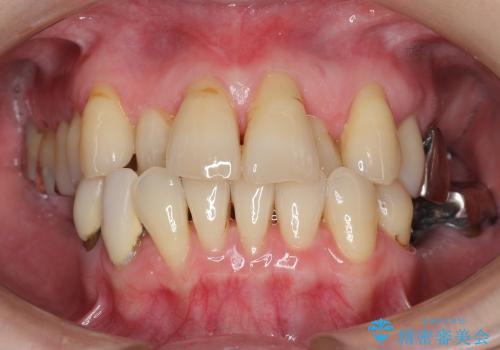 骨幅が薄い　奥歯のインプラント治療　GBR(骨増生)の治療前