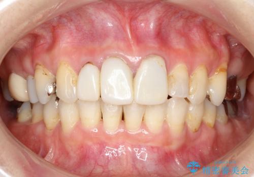 40代女性　矯正後の前歯の完成の治療前