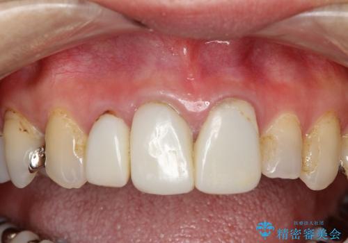 40代女性　矯正後の前歯の完成の治療前