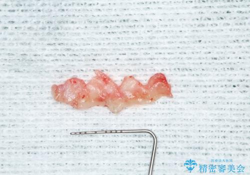 40代女性　矯正後の前歯の完成の治療中