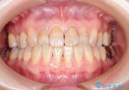 虫歯で切端咬合の前歯　咬み合わせを改善してからオールセラミックへの治療前