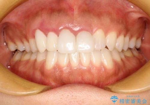 前歯のかぶせ物のやり変えによる歯肉の腫れの改善の治療前