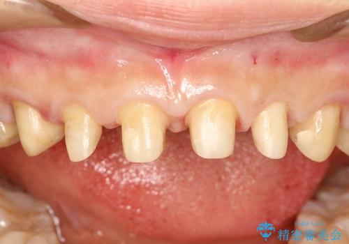 30代女性　前歯の長さを変える　オールセラミックの治療中