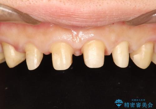 30代女性　前歯の長さを変える　オールセラミックの治療中